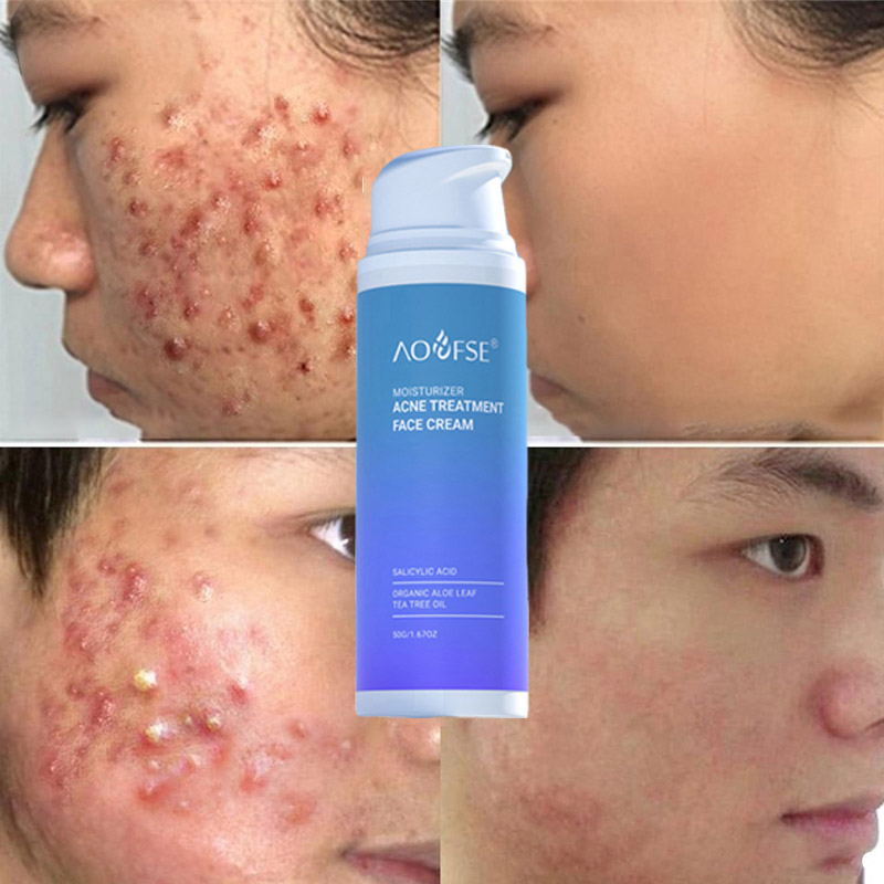 natural acne cream